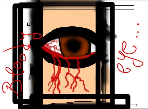 bloody eye